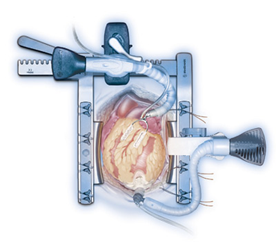 Koronare-Bypasschirurgie_Abb3 Koronare-Bypasschirurgie_Abb3