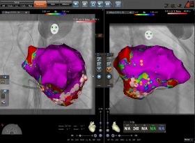 Ablation von Kammertachykardien Ablation von Kammertachykardien